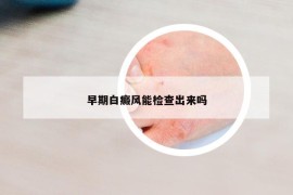 早期白癜风能检查出来吗