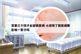 家里三个孩子全部银屑病 小孩得了银屑病要影响一辈子吗