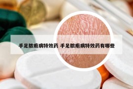 手足脓疱病特效药 手足脓疱病特效药有哪些