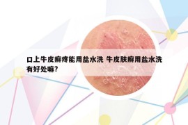 口上牛皮癣疼能用盐水洗 牛皮肤癣用盐水洗有好处嘛?