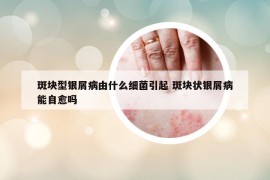 斑块型银屑病由什么细菌引起 斑块状银屑病能自愈吗