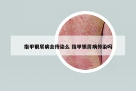 指甲银屑病会传染么 指甲银屑病传染吗