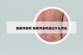 股癣传染吗 股癣传染吗通过什么传染