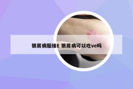 银屑病服维E 银屑病可以吃ve吗