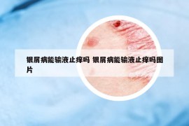 银屑病能输液止痒吗 银屑病能输液止痒吗图片