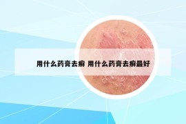 用什么药膏去癣 用什么药膏去癣最好