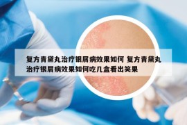 复方青黛丸治疗银屑病效果如何 复方青黛丸治疗银屑病效果如何吃几盒看出笑果