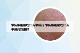 掌跖脓疱病吃什么中成药 掌跖脓疱病吃什么中成药效果好