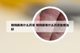 铜钱癣用什么药膏 铜钱癣用什么药膏能根治好