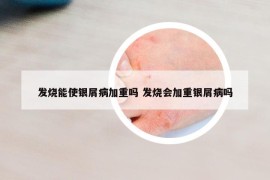 发烧能使银屑病加重吗 发烧会加重银屑病吗