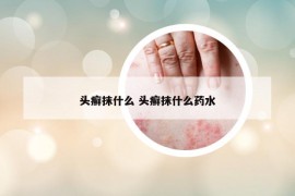 头癣抹什么 头癣抹什么药水