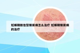 妊娠期脓包型银屑病怎么治疗 妊娠期银屑病的治疗