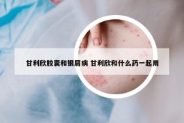 甘利欣胶囊和银屑病 甘利欣和什么药一起用