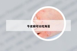 牛皮癣可以吃海苔