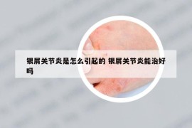 银屑关节炎是怎么引起的 银屑关节炎能治好吗