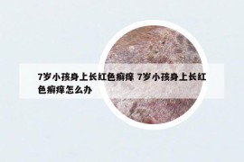 7岁小孩身上长红色癣痒 7岁小孩身上长红色癣痒怎么办