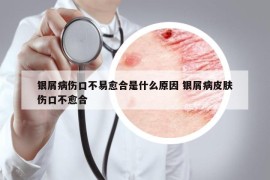 银屑病伤口不易愈合是什么原因 银屑病皮肤伤口不愈合