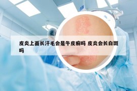 皮炎上面长汗毛会是牛皮癣吗 皮炎会长白斑吗