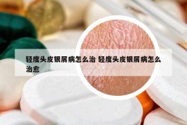 轻度头皮银屑病怎么治 轻度头皮银屑病怎么治愈