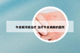 牛皮癣河南治疗 治疗牛皮病癣的医院