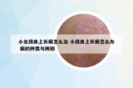 小女孩身上长癣怎么治 小孩身上长癣怎么办 癣的种类与辨别