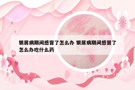 银屑病期间感冒了怎么办 银屑病期间感冒了怎么办吃什么药