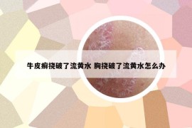 牛皮癣挠破了流黄水 胸挠破了流黄水怎么办