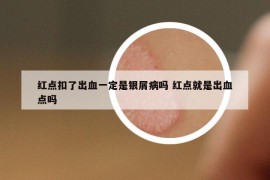 红点扣了出血一定是银屑病吗 红点就是出血点吗