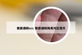 银屑病和scc 银屑病和梅毒对比照片