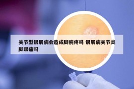 关节型银屑病会造成脚腕疼吗 银屑病关节炎脚跟痛吗