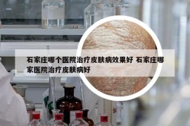 石家庄哪个医院治疗皮肤病效果好 石家庄哪家医院治疗皮肤病好