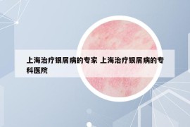 上海治疗银屑病的专家 上海治疗银屑病的专科医院