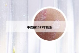 牛皮癣2023年能治