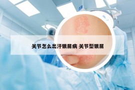 关节怎么出汗银屑病 关节型银屑