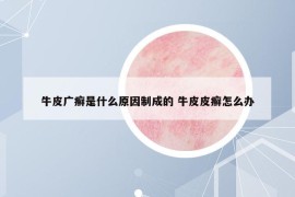 牛皮广癣是什么原因制成的 牛皮皮癣怎么办