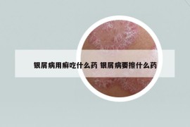 银屑病用癣吃什么药 银屑病要擦什么药