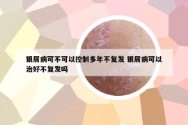 银屑病可不可以控制多年不复发 银屑病可以治好不复发吗