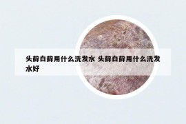 头藓白藓用什么洗发水 头藓白藓用什么洗发水好