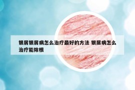 银屑银屑病怎么治疗最好的方法 银屑病怎么治疗能除根