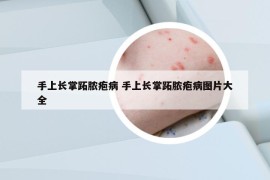 手上长掌跖脓疱病 手上长掌跖脓疱病图片大全