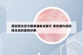 库欣综合征与银屑病有关联不 库欣病与库欣综合征的鉴别诊断