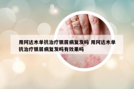 用阿达木单抗治疗银屑病复发吗 用阿达木单抗治疗银屑病复发吗有效果吗