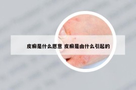 皮癣是什么愿意 皮癣是由什么引起的