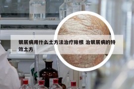 银屑病用什么土方法治疗除根 治银屑病的特效土方