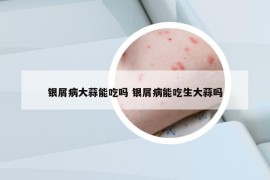 银屑病大蒜能吃吗 银屑病能吃生大蒜吗