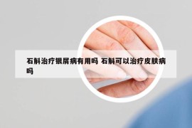 石斛治疗银屑病有用吗 石斛可以治疗皮肤病吗