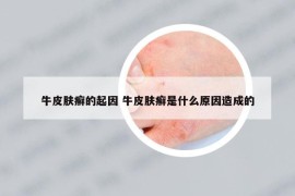 牛皮肤癣的起因 牛皮肤癣是什么原因造成的