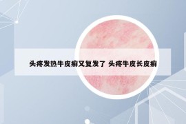 头疼发热牛皮癣又复发了 头疼牛皮长皮癣