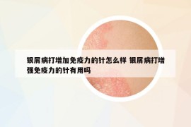 银屑病打增加免疫力的针怎么样 银屑病打增强免疫力的针有用吗