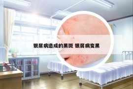 银屑病造成的黑斑 银屑病变黑